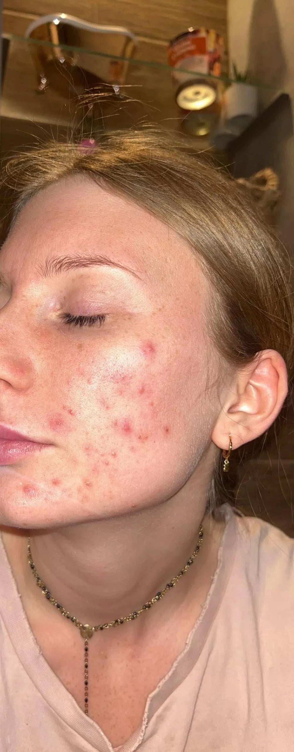 Veido kaukė su LED šviesos terapija, fotoninė, medicininis silikonas